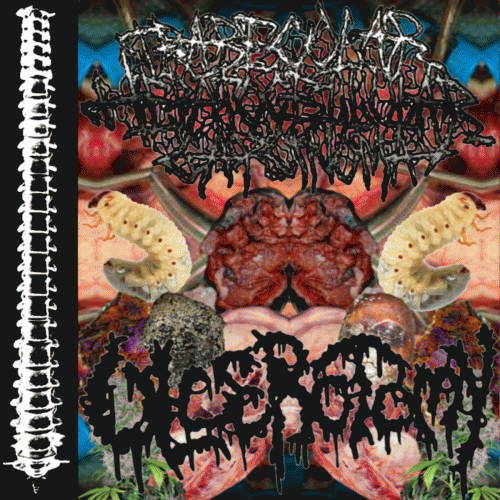 Trabecular Hepatocellular Carcinoma : Trabecular Hepatocellular Carcinoma - Ulcerotomy